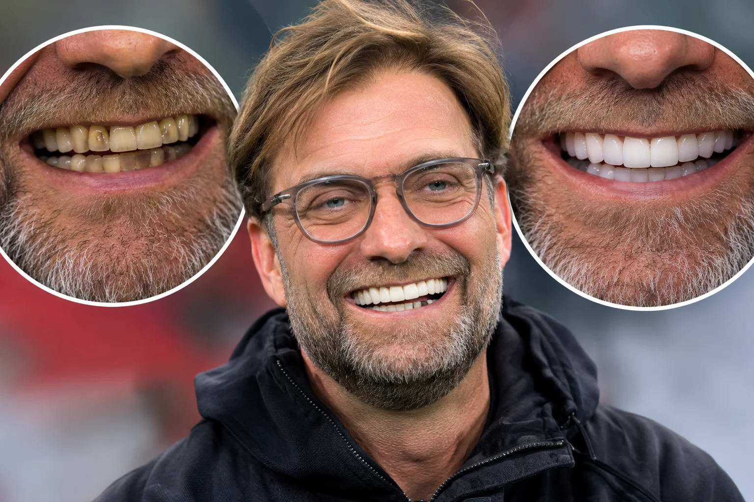 Jürgen Klopp Zähne